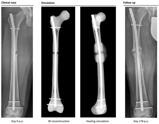 Comparison of 4 Methods for Dynamization of Locking Plates: Differences in  the Amount and Type of Fracture Motion. - Abstract - Europe PMC