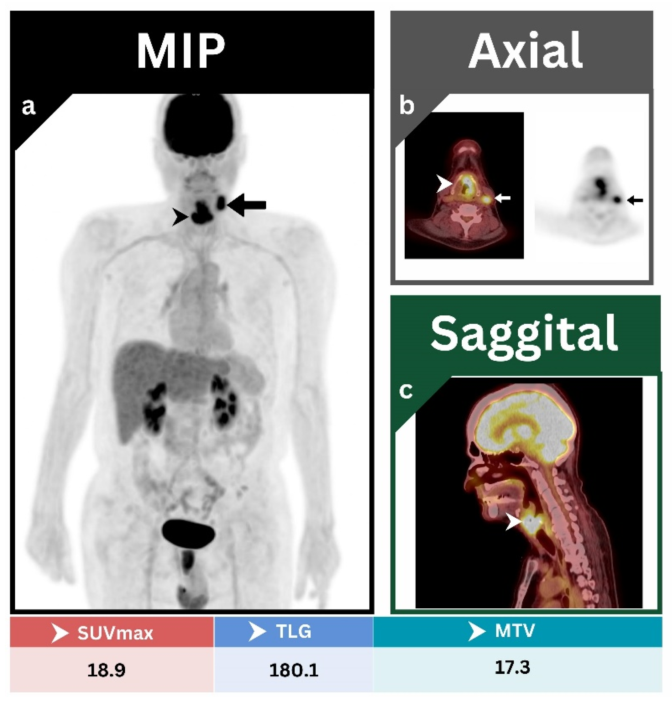 JCM Free Full Text The Prognostic And Diagnostic Value Of 18F FDG diagnostics-free-full-text-pretreatment-18f-fdg-pet-ct-prognostic