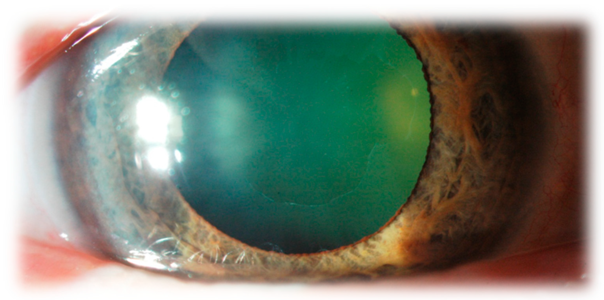 JCM Free FullText Pseudoexfoliation Syndrome—Clinical