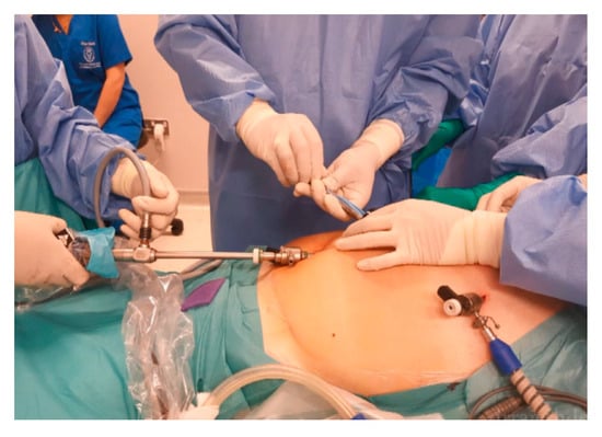 Single-site in-bag morcellation achieved via direct puncture of the  pneumoperitoneum cap, a cordless electric morcellator, and a