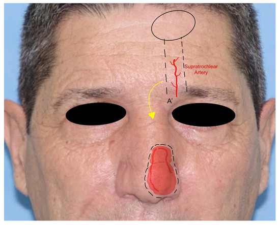 Locoregional Flaps for the Reconstruction of Midface Skin Defects