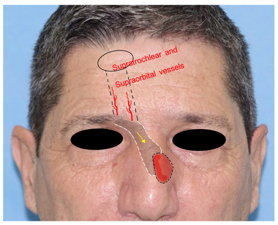 Locoregional Flaps for the Reconstruction of Midface Skin