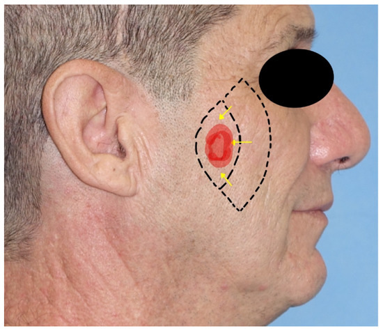 Locoregional Flaps for the Reconstruction of Midface Skin Defects
