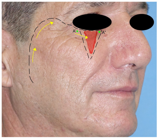 Local Flaps in Facial Reconstruction: Text with DVD