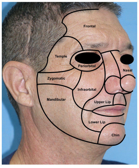 Locoregional Flaps for the Reconstruction of Midface Skin