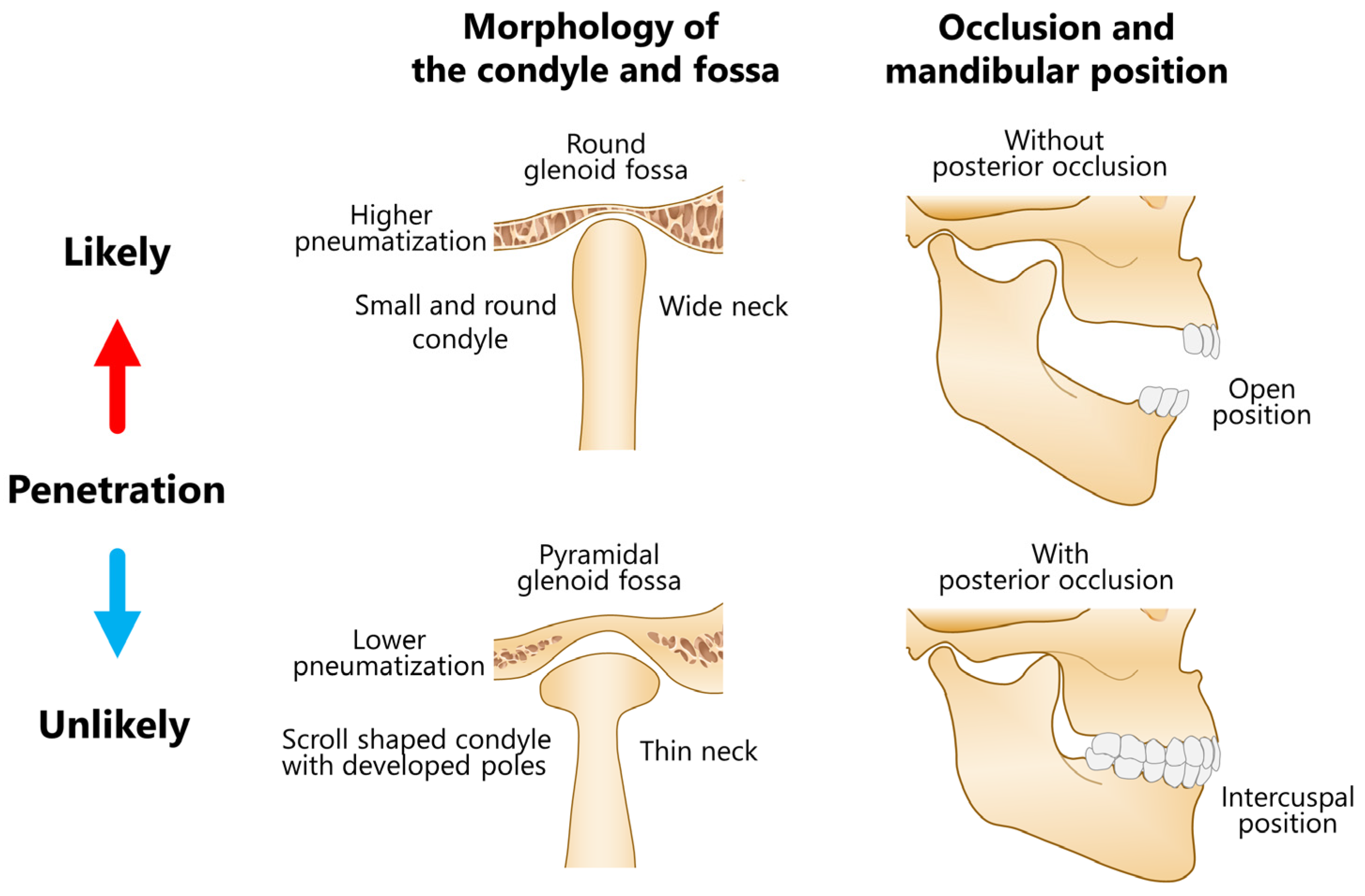 JCM | Free Full-Text | Superior Dislocation of the Mandibular Condyle into  the Middle Cranial Fossa: A Comprehensive Review of the Literature