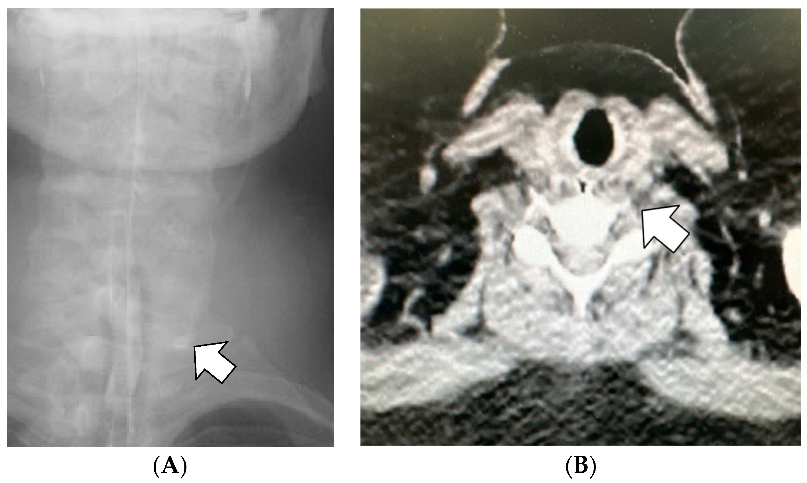 JCM | Free Full-Text | Piriform Fossa Injury during Calibration Tube  Insertion in Laparoscopic Sleeve Gastrectomy