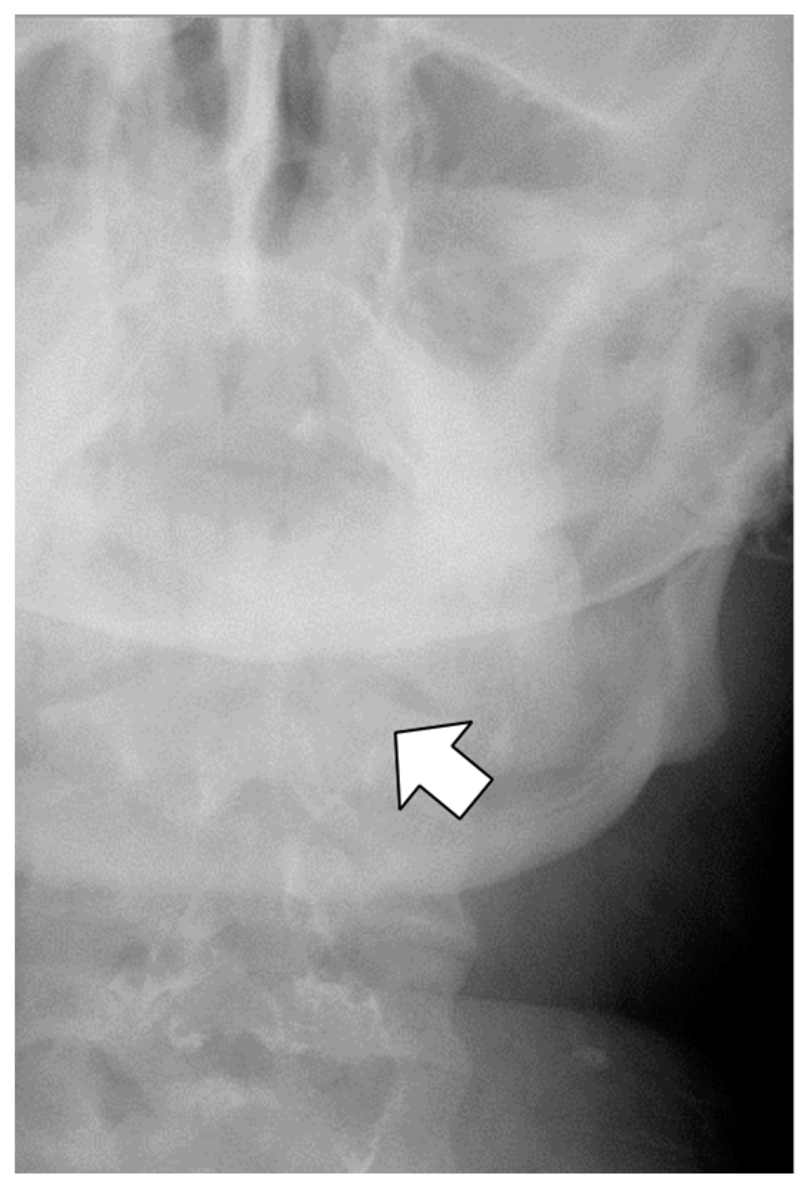 JCM | Free Full-Text | Piriform Fossa Injury during Calibration Tube  Insertion in Laparoscopic Sleeve Gastrectomy