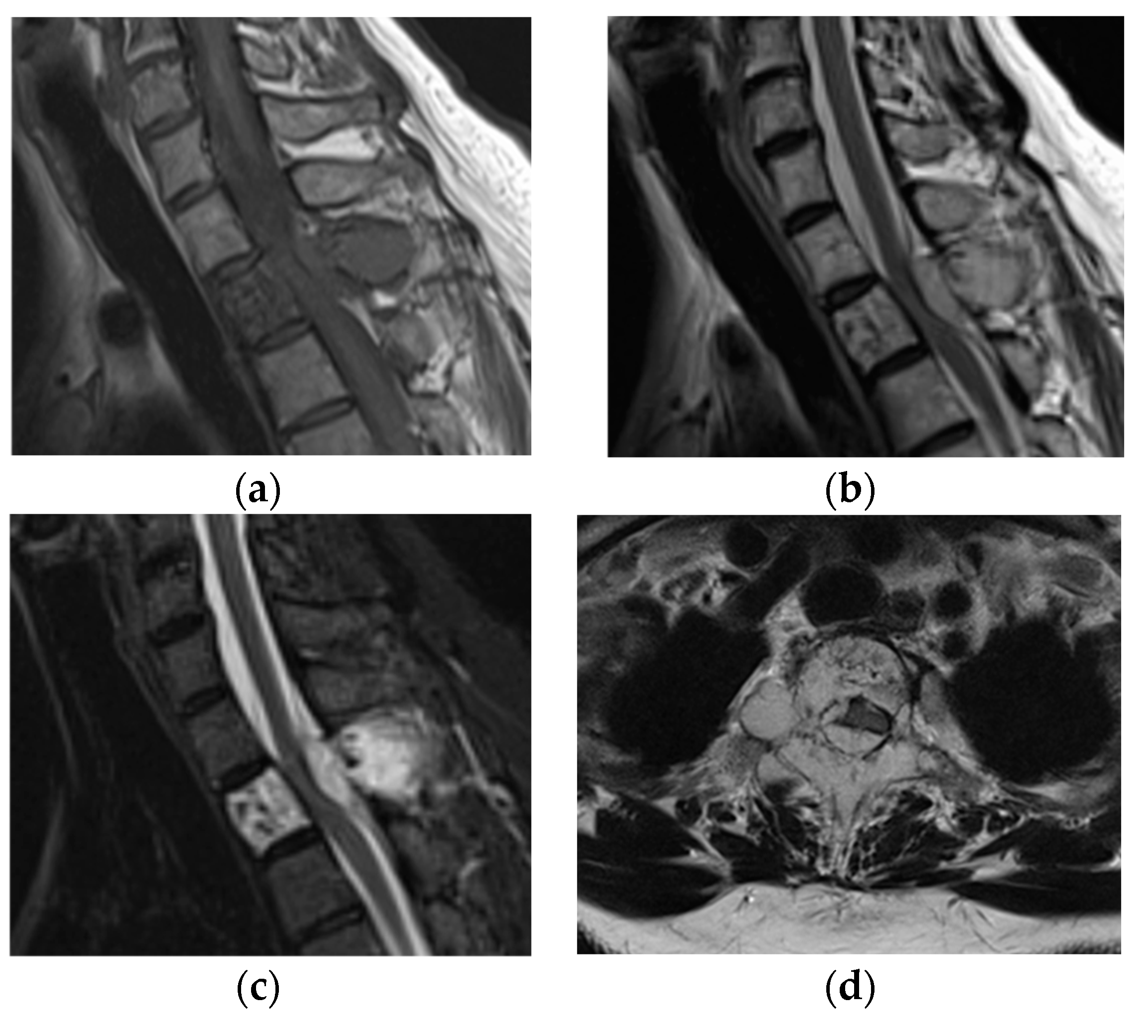 Ethanol Sclerosis Therapy for Aggressive Vertebral Hemangioma of the ...
