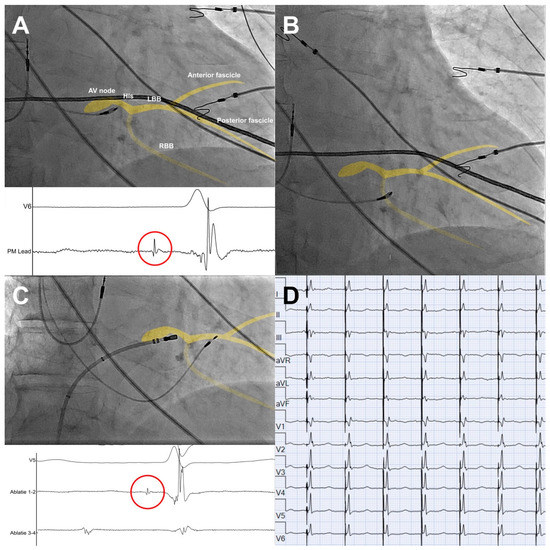JCM Free FullText Left Bundle Branch Area Pacing and