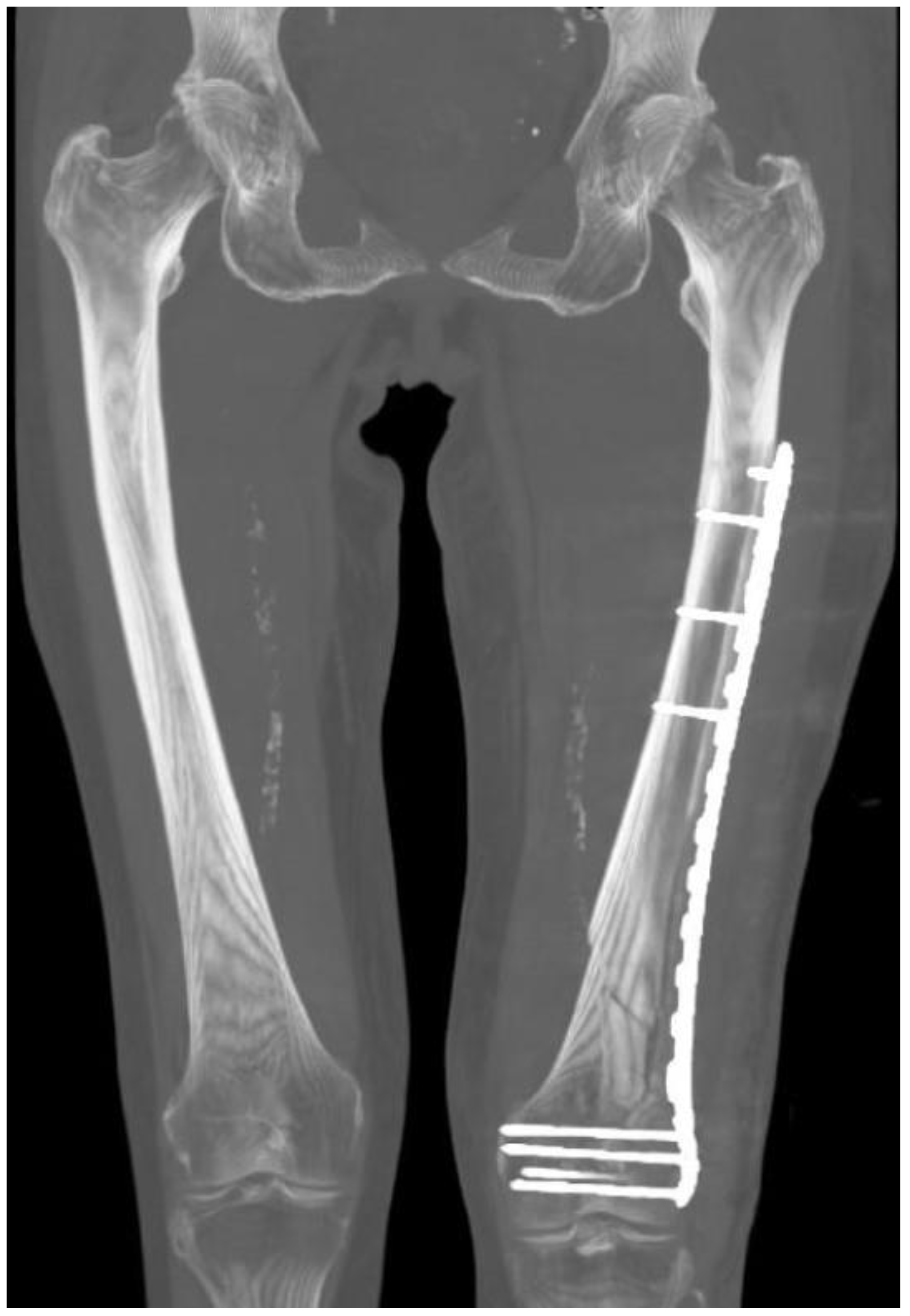 JCM Free FullText Using a Traction Table for Fracture Reduction