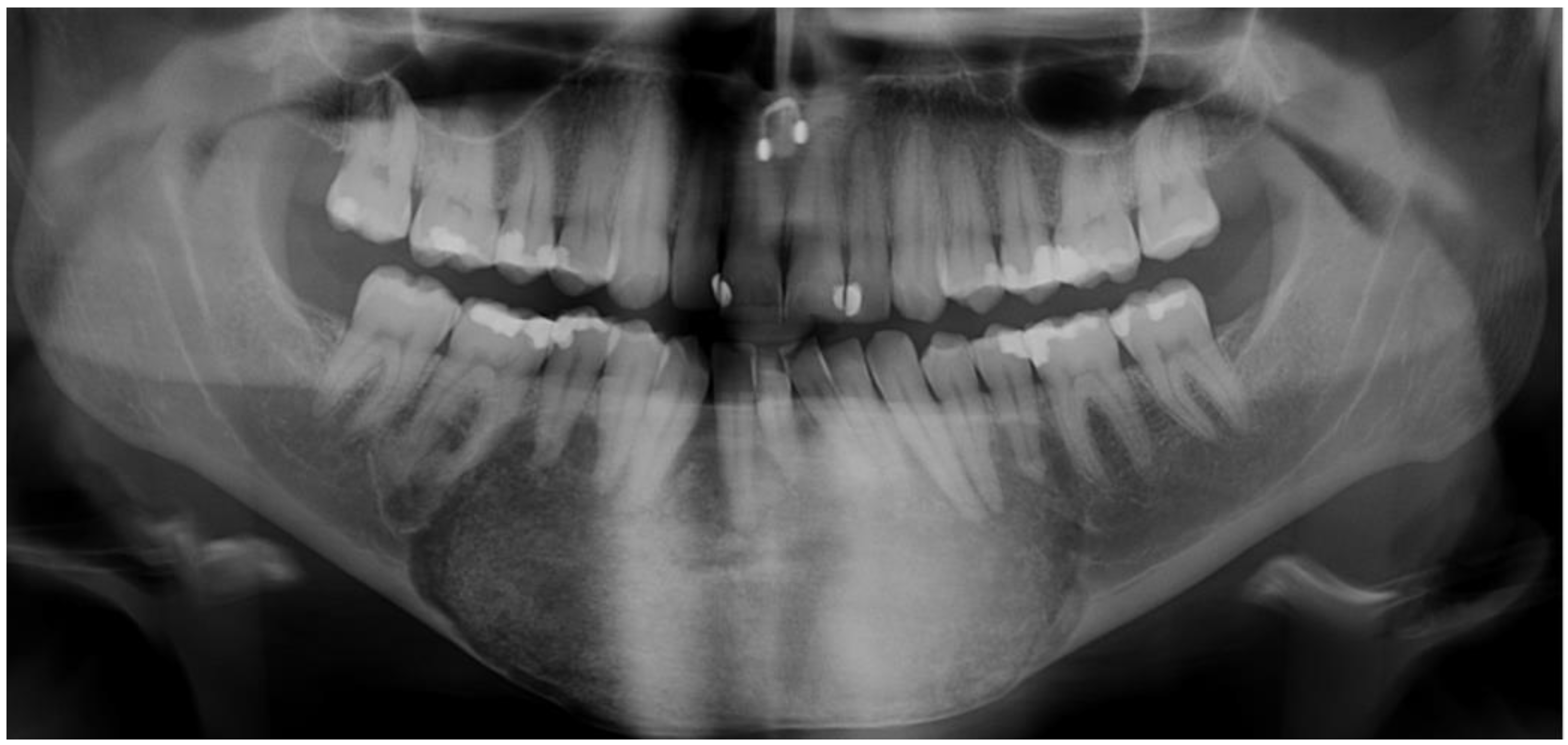 JCM Free FullText Fibrous Dysplasia of the Jaw Advances in