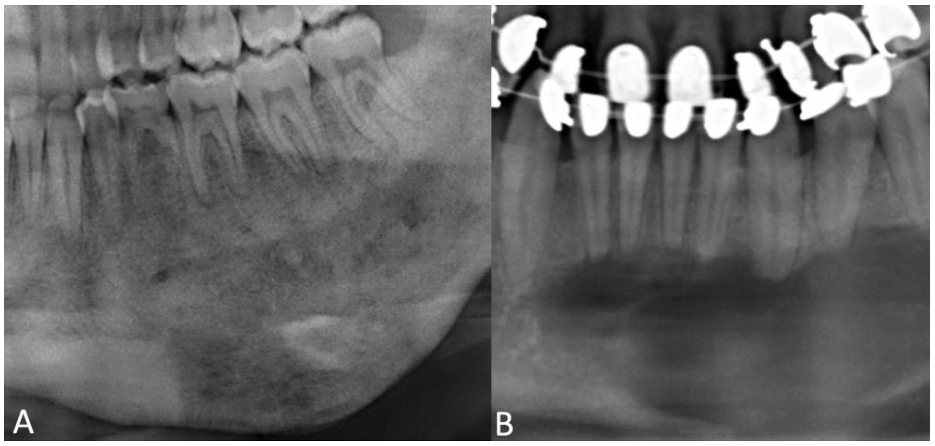 Dentin Dysplasia Radiograph