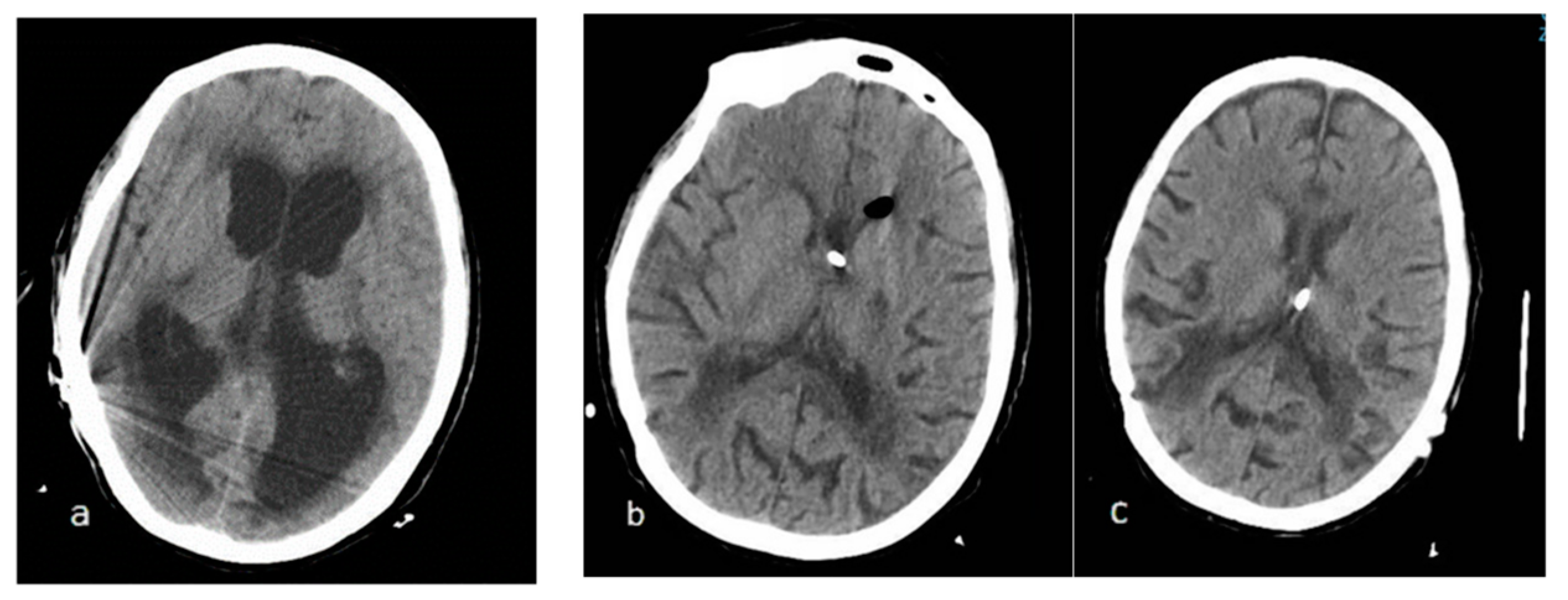 Low and negative pressure hydrocephalus new report of six cases and