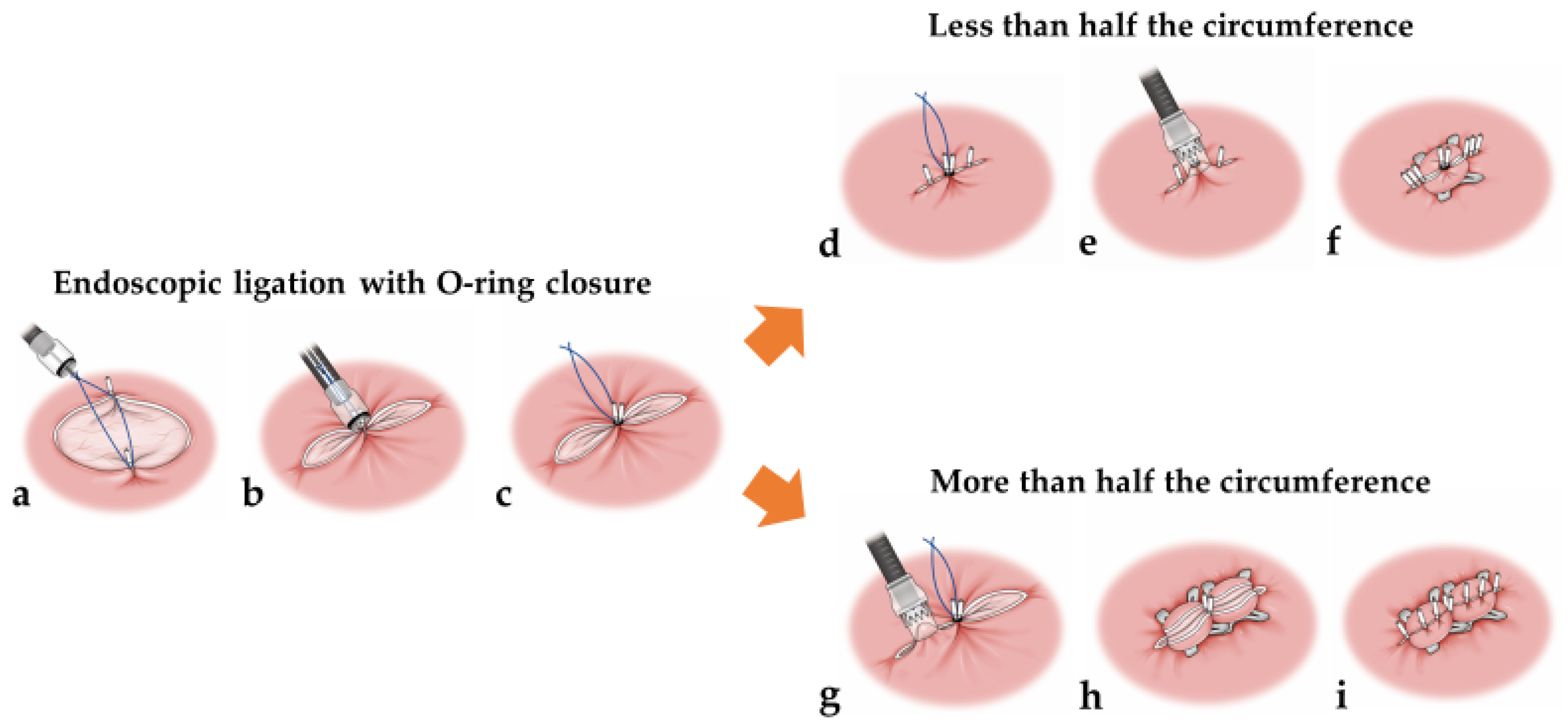Effective and secure closure after duodenal endoscopic submucosal