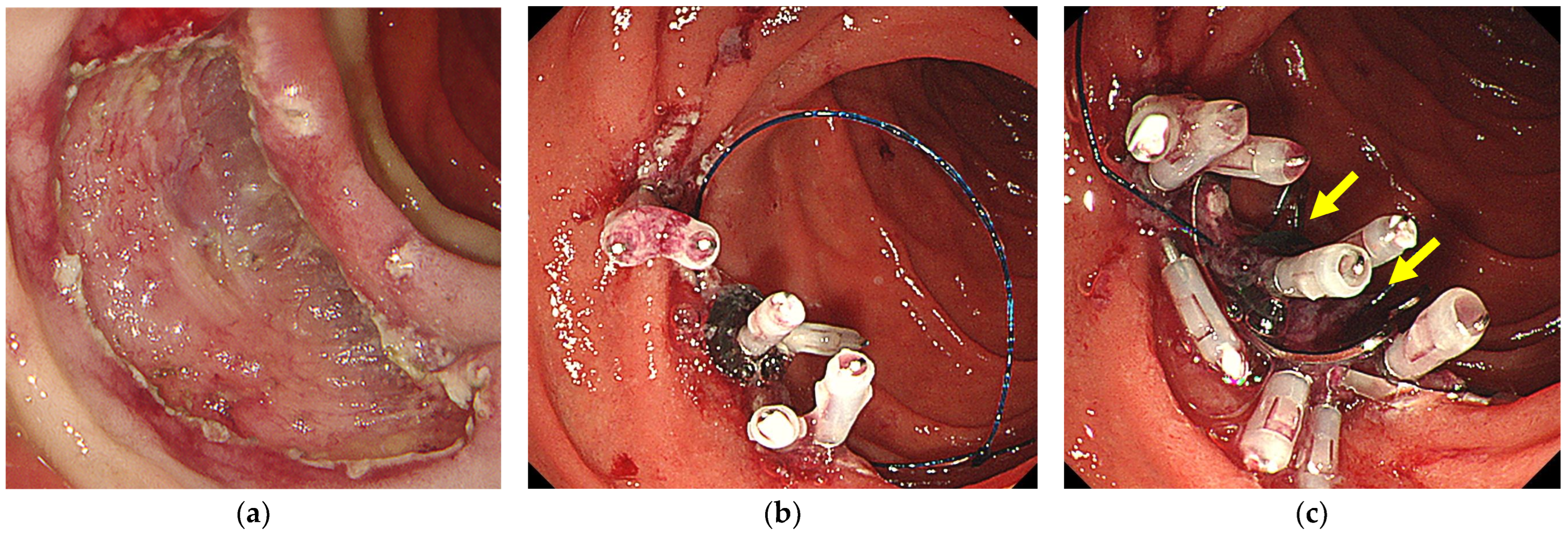 Endoscopic clip closure techniques used in the present study. a