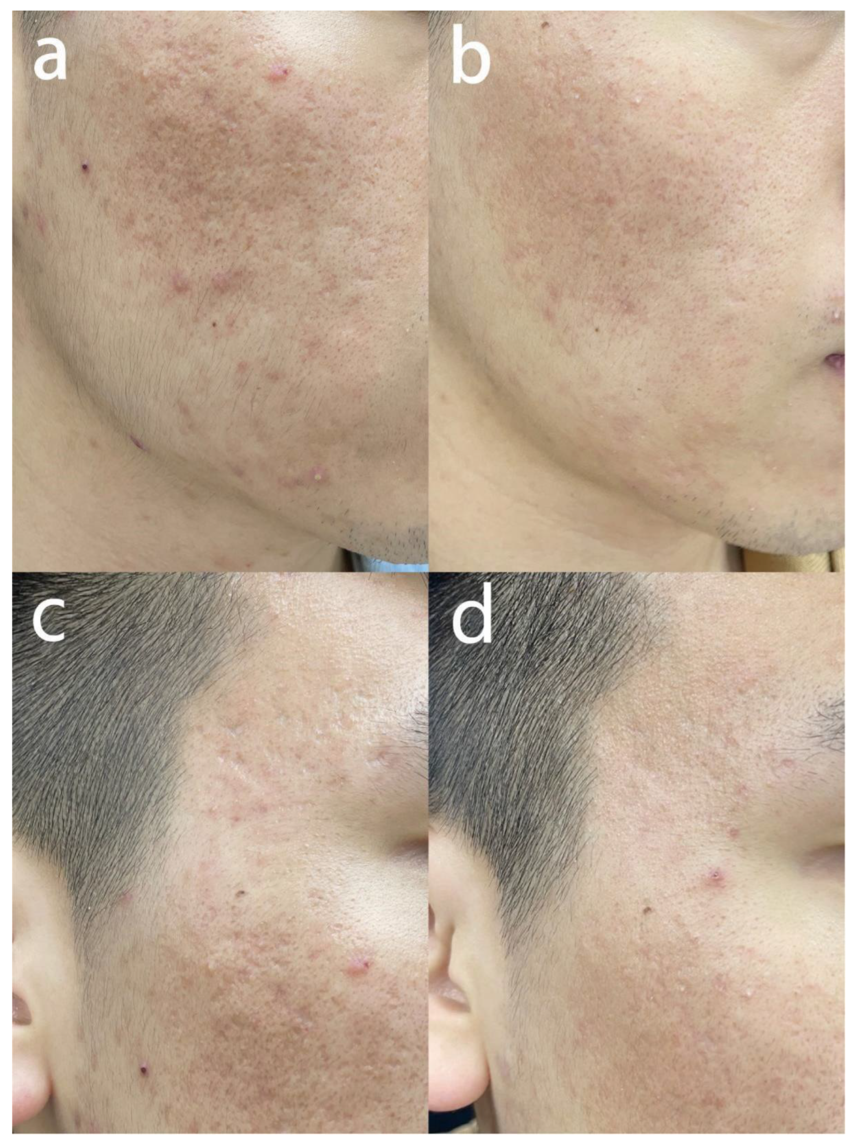 JCM Free Full Text Multiple Mode Procedures of Ultra Pulse