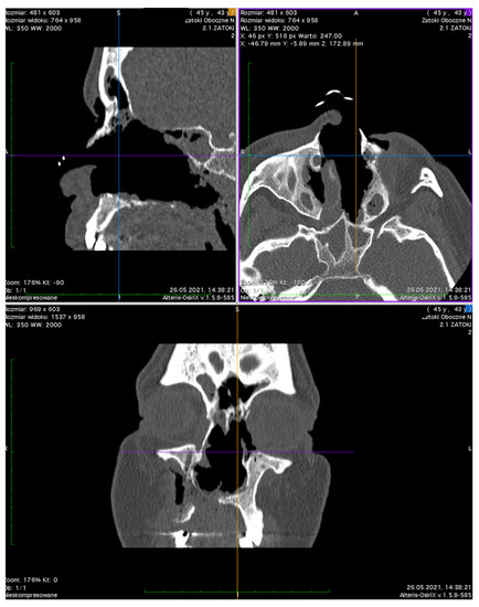 Ocular Involvement of Granulomatosis with Polyangiitis