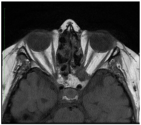 Ocular Involvement of Granulomatosis with Polyangiitis