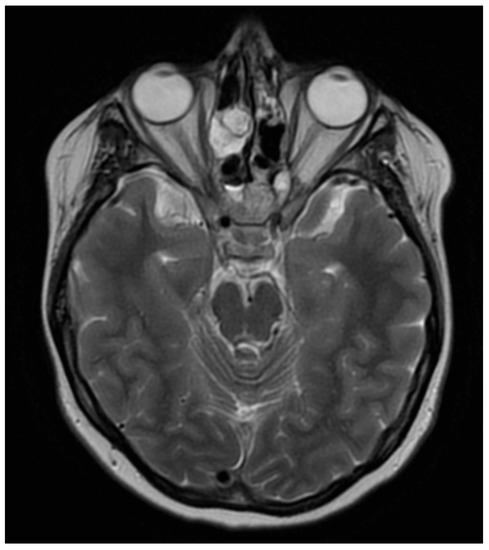 Ocular Involvement of Granulomatosis with Polyangiitis