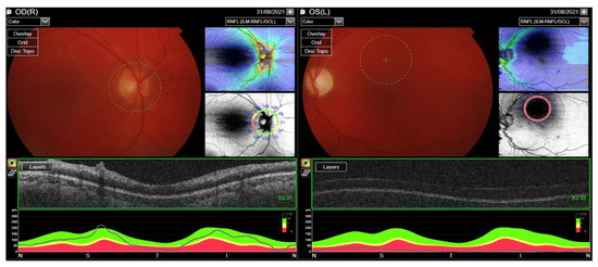 Ocular Involvement of Granulomatosis with Polyangiitis