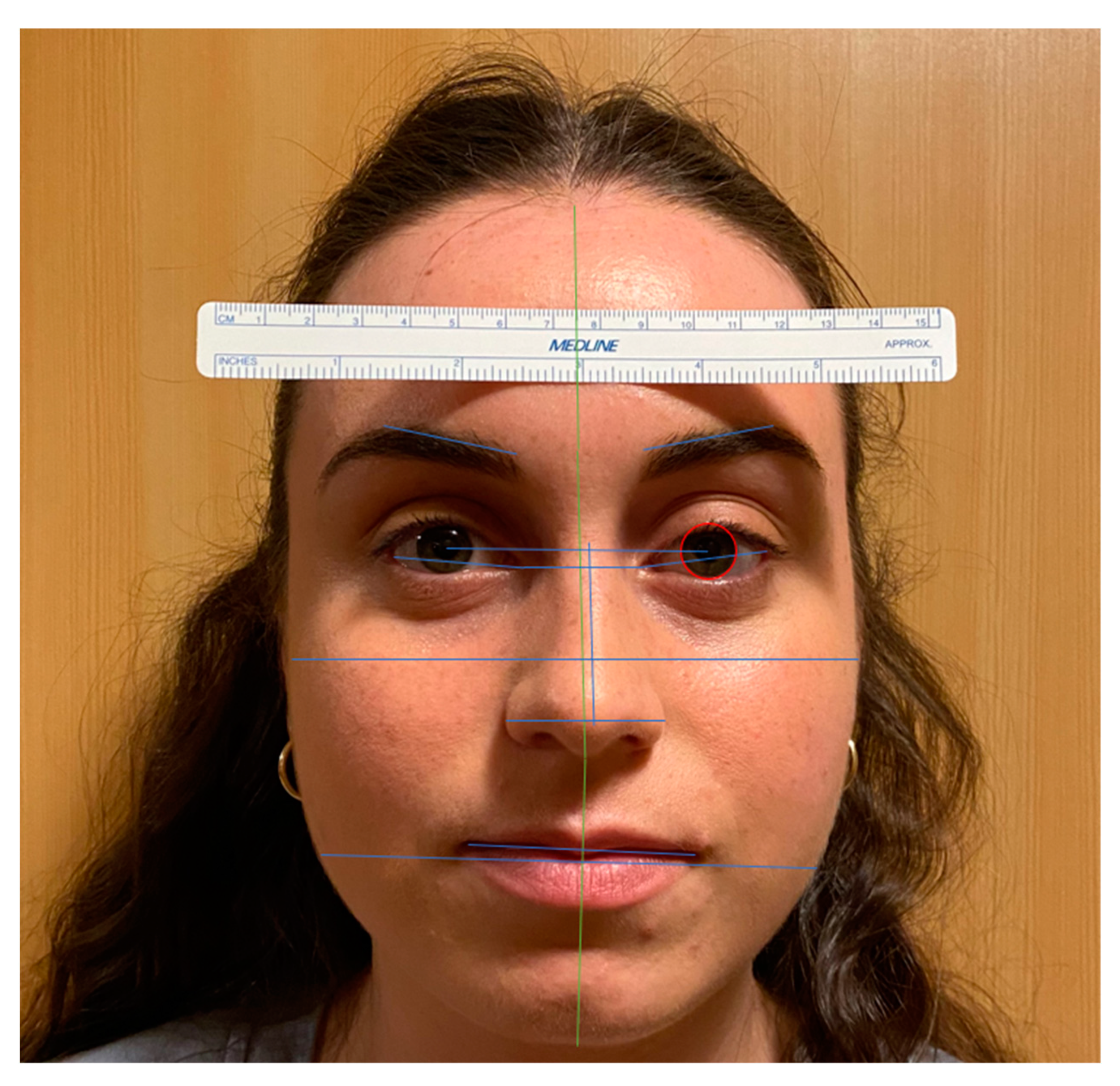 JCM Free Full-Text Facial Morphometrics in Black Celebrities Contemporary Facial Analysis Using an Artificial Intelligence Platform