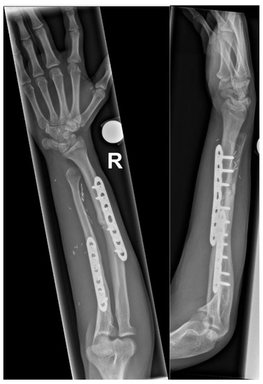 Vascularized Growth Plate Transfer in Paediatric Ulna Non-Union ...