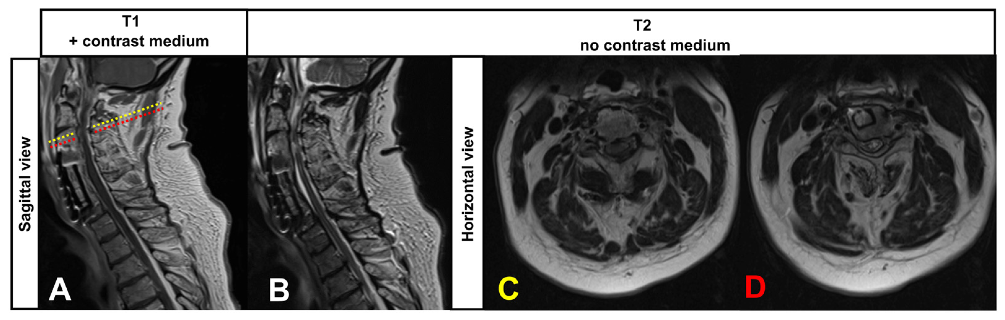 JCM Free FullText Diagnosis of Froin’s Syndrome by Parallel