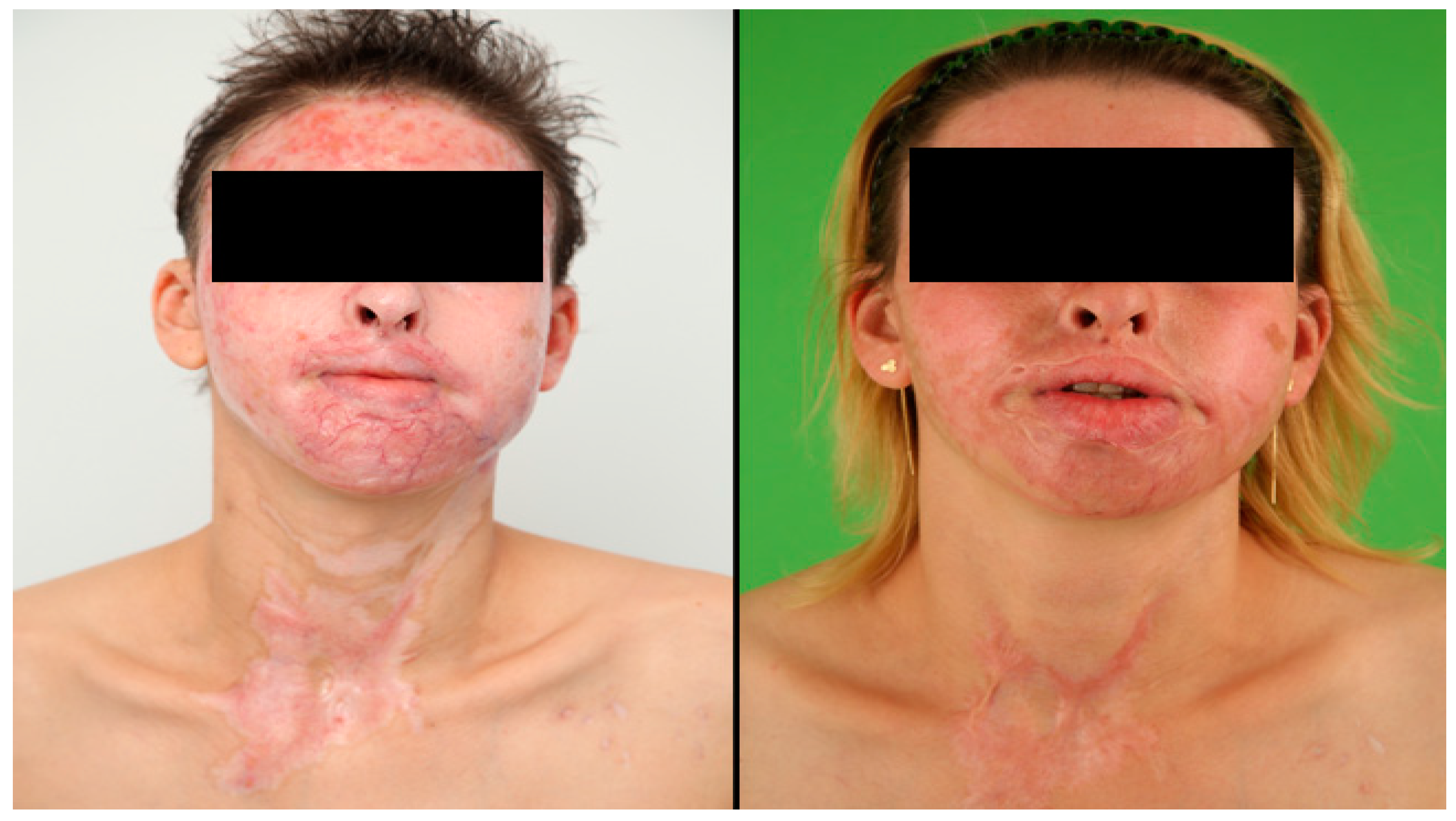 JCM Free FullText The Impact of Facial Burns on Short and Long