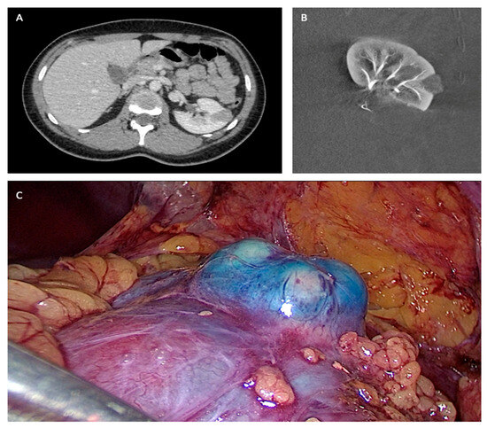 Long-Term Oncological and Functional Outcomes after Laparoscopic