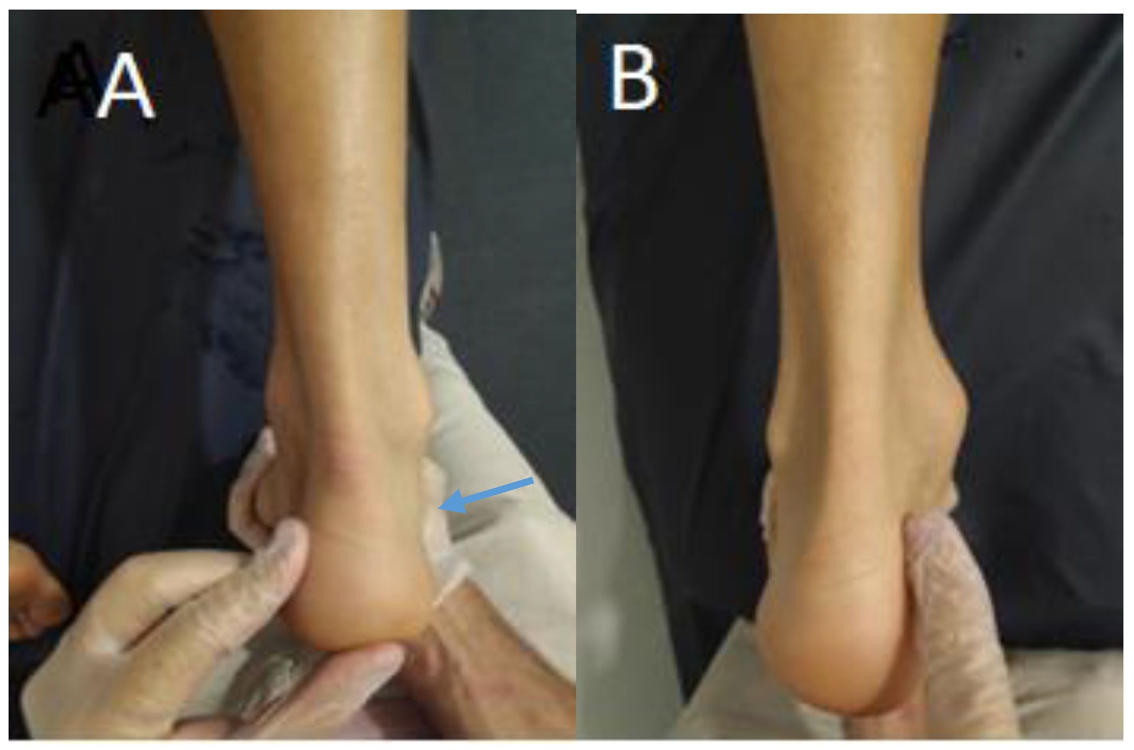 Achilles sales tendon pad