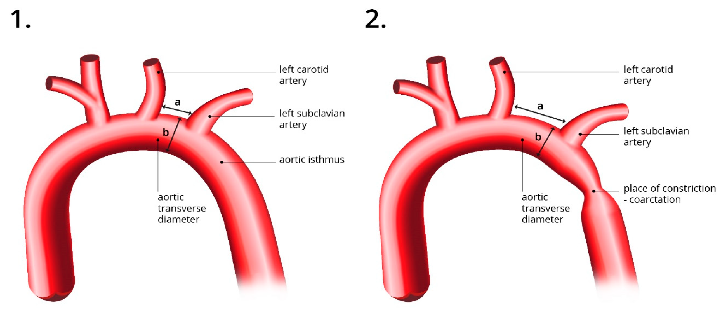 transverse arch aorta