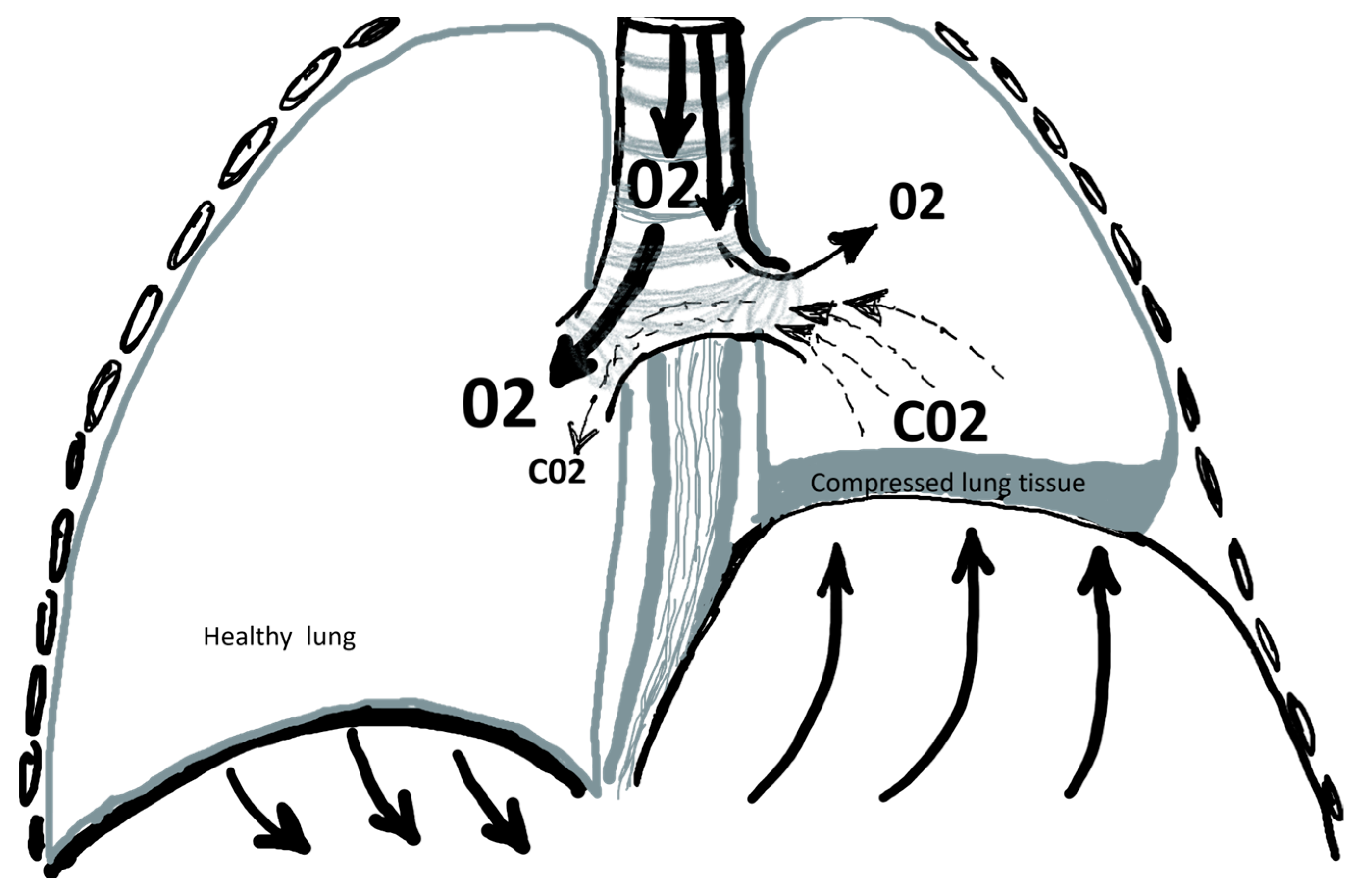 JCM Free FullText MinimallyInvasive Diaphragmatic Plication in