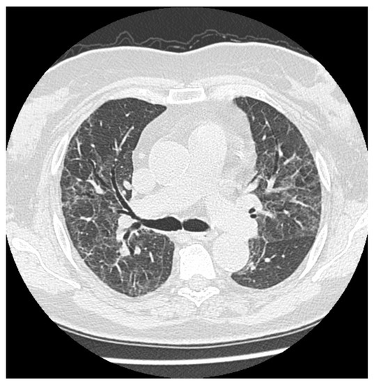 What Remains up to 7 Months after Severe and Moderate Pneumonia in Non