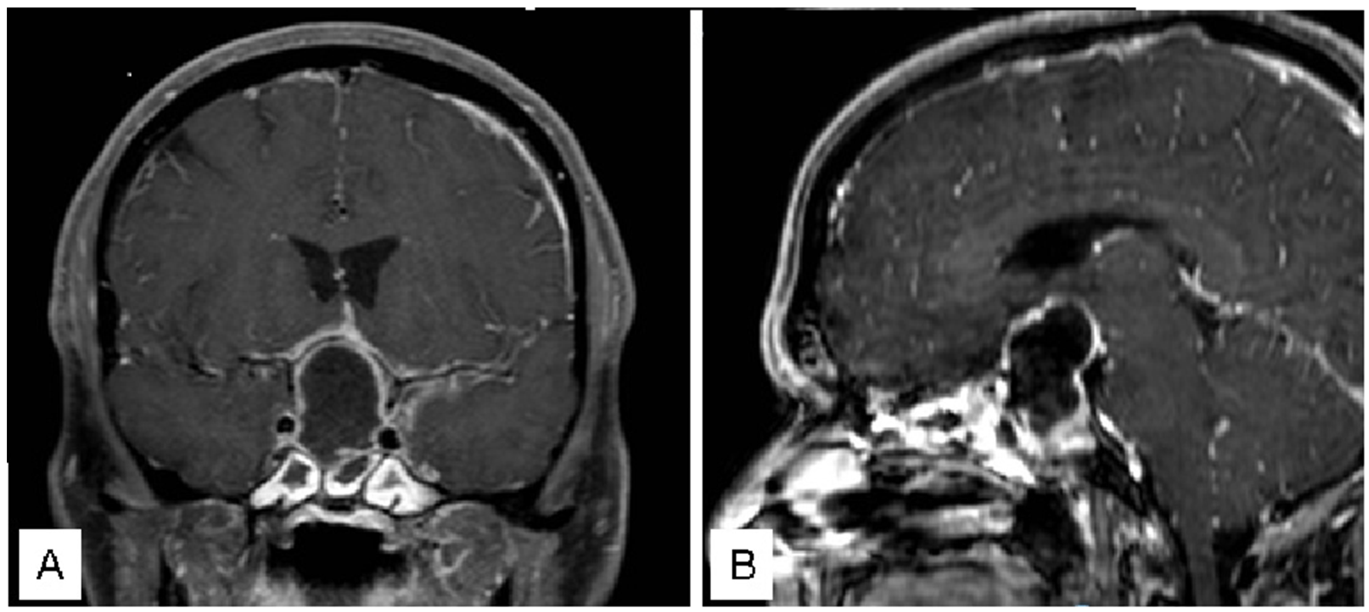 JCM | Free Full-Text | Ultra-Early Treatment of Neurosurgical Emergencies  with Endoscopic Endonasal Approach: Experience from Three Italian Referral  Centers