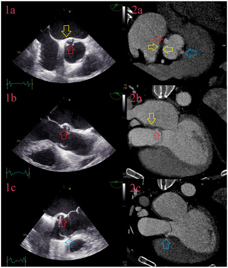 The Role of Echocardiography and Cardiac Computed Tomography in