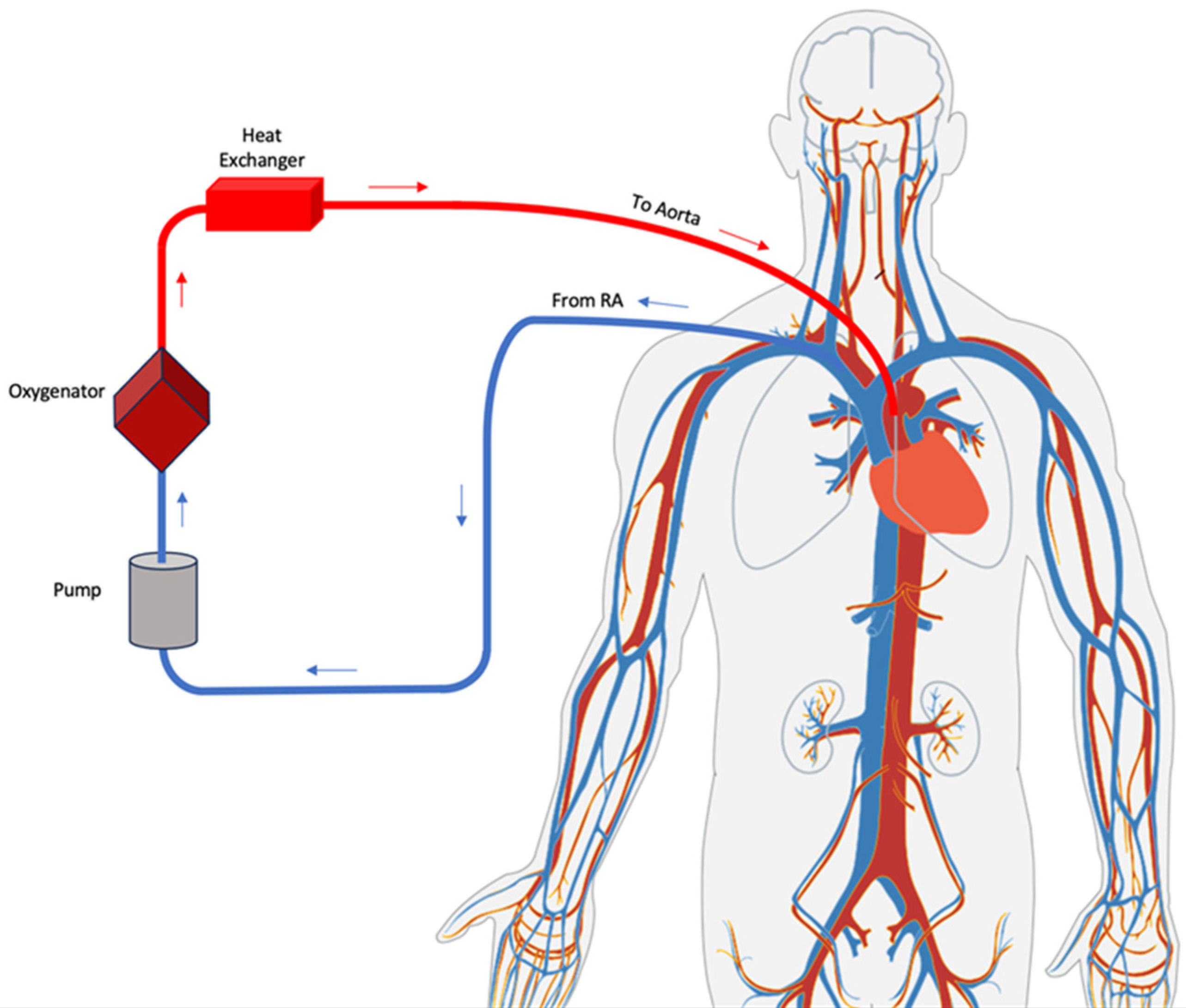 Vv Ecmo Circuit vv-ecmo-circuit