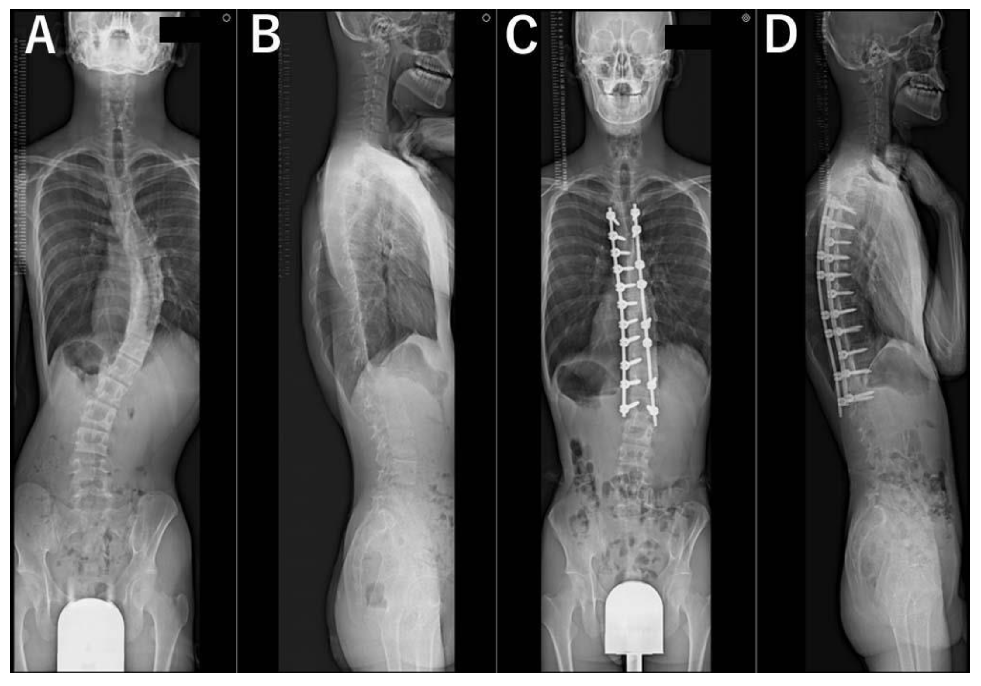 Sleeping With Scoliosis and Spinal Fusion