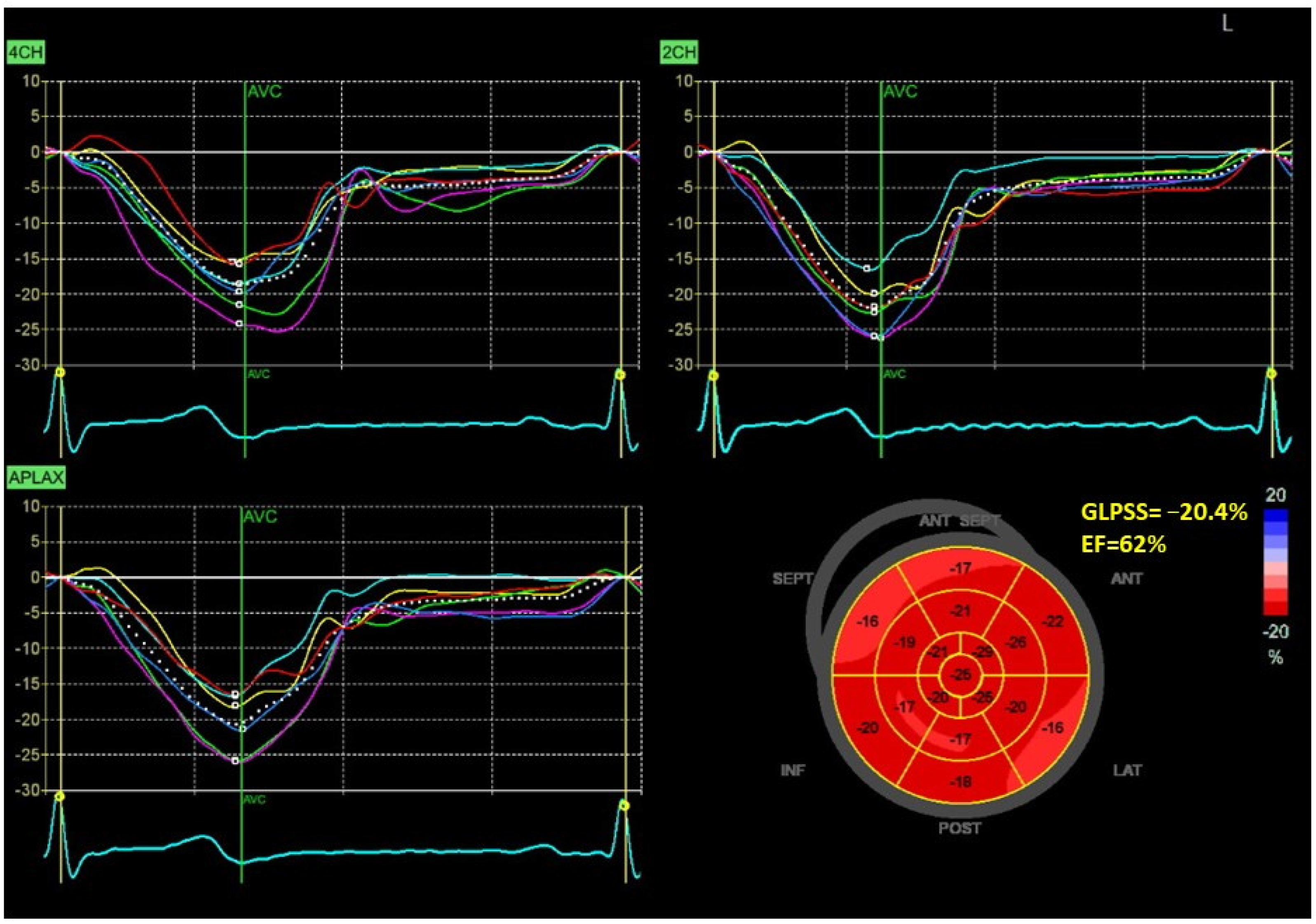Strain Echocardiography part II: General concept 