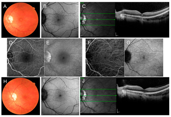 Stargardt's disease presenting with bilateral central ring scotoma -  ScienceDirect