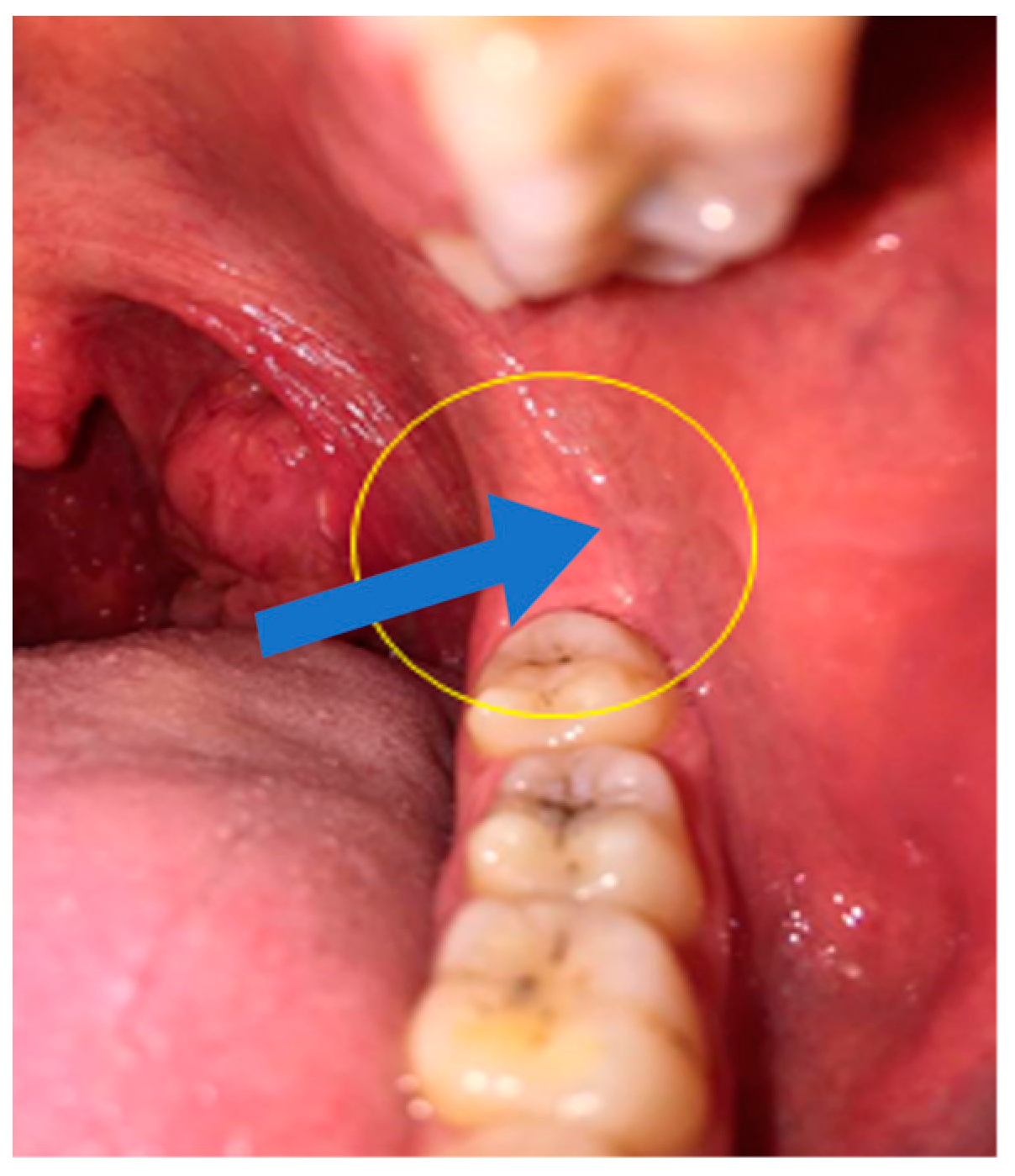 Mandibular Nerve Block: Background, Indications, Contraindications