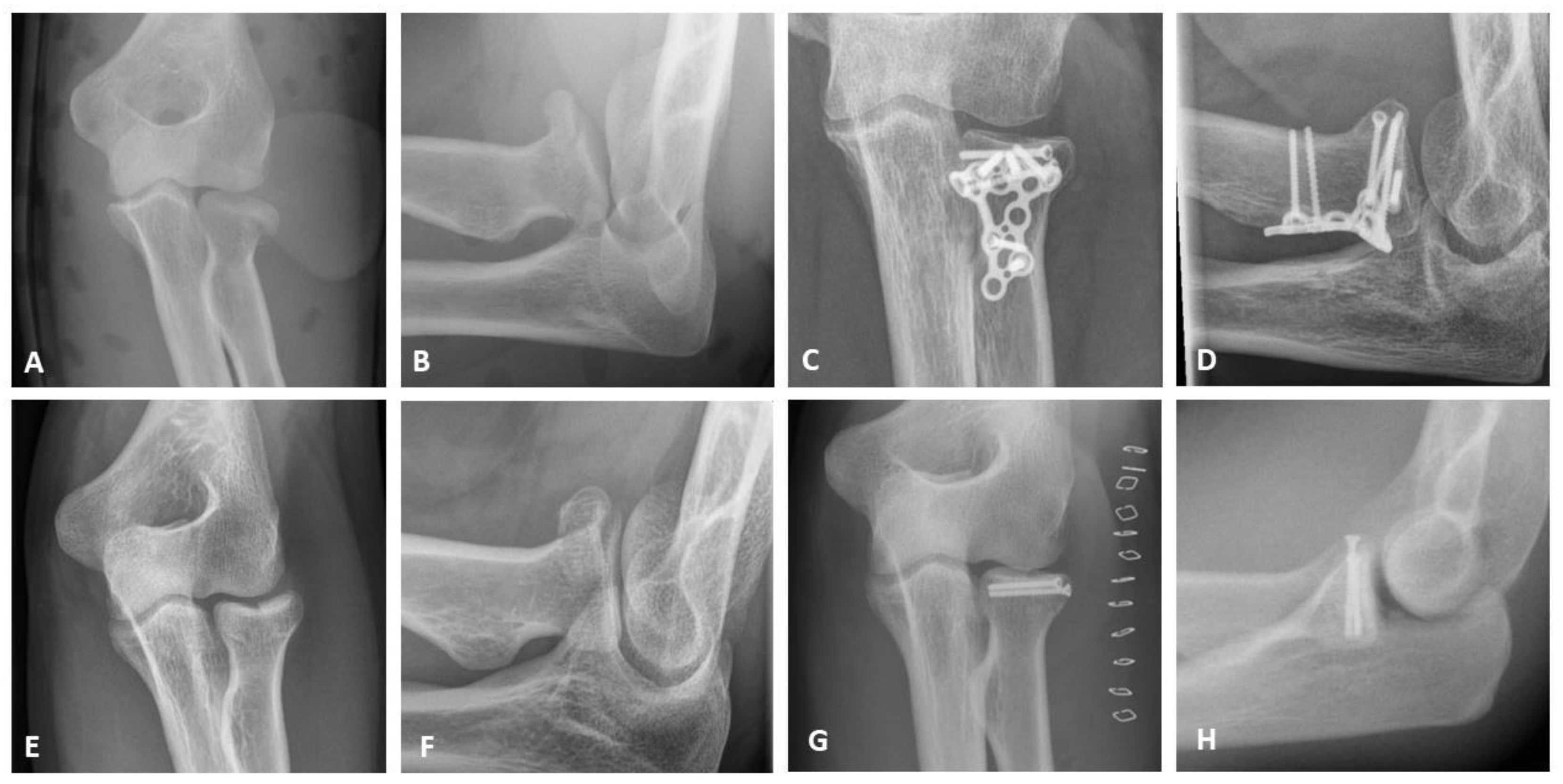 JCM Free FullText Functional Postoperative for 92 Cases of Radial Head Fractures A