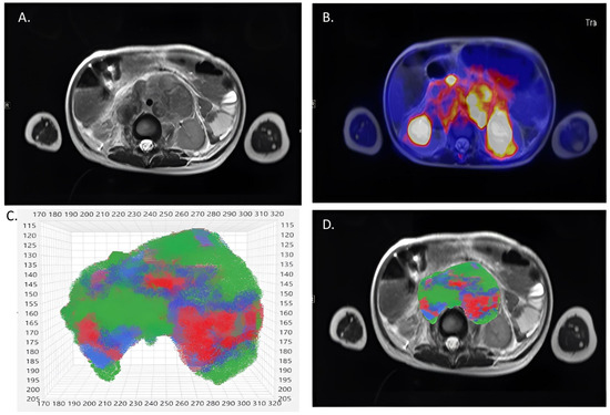 Combined Metabolic and Functional Tumor Volumes on [18F]FDG-PET/MRI in ...