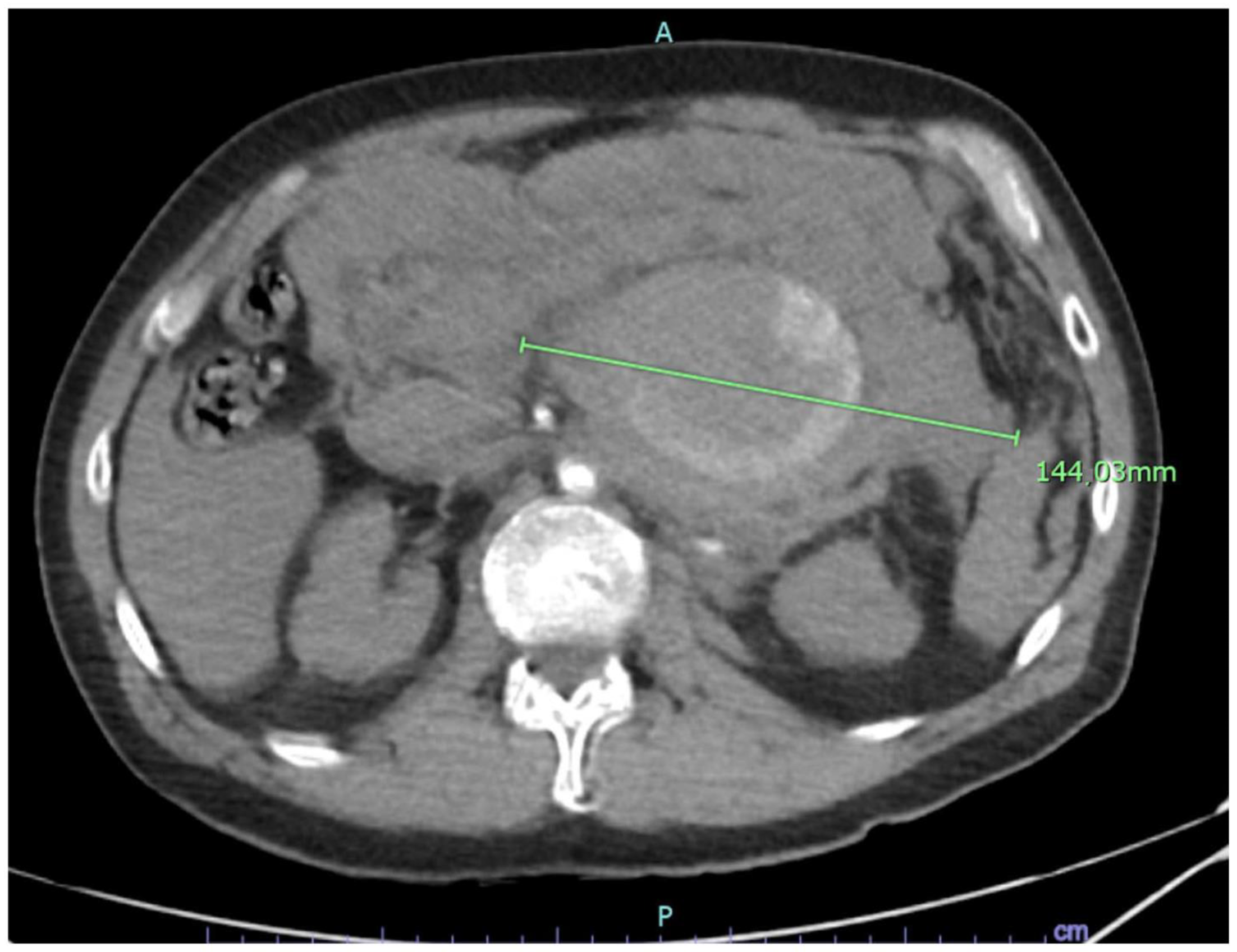 Splenic Artery Aneurysm: Accurate Icd 10 Coding Explained - 0b2dfyr