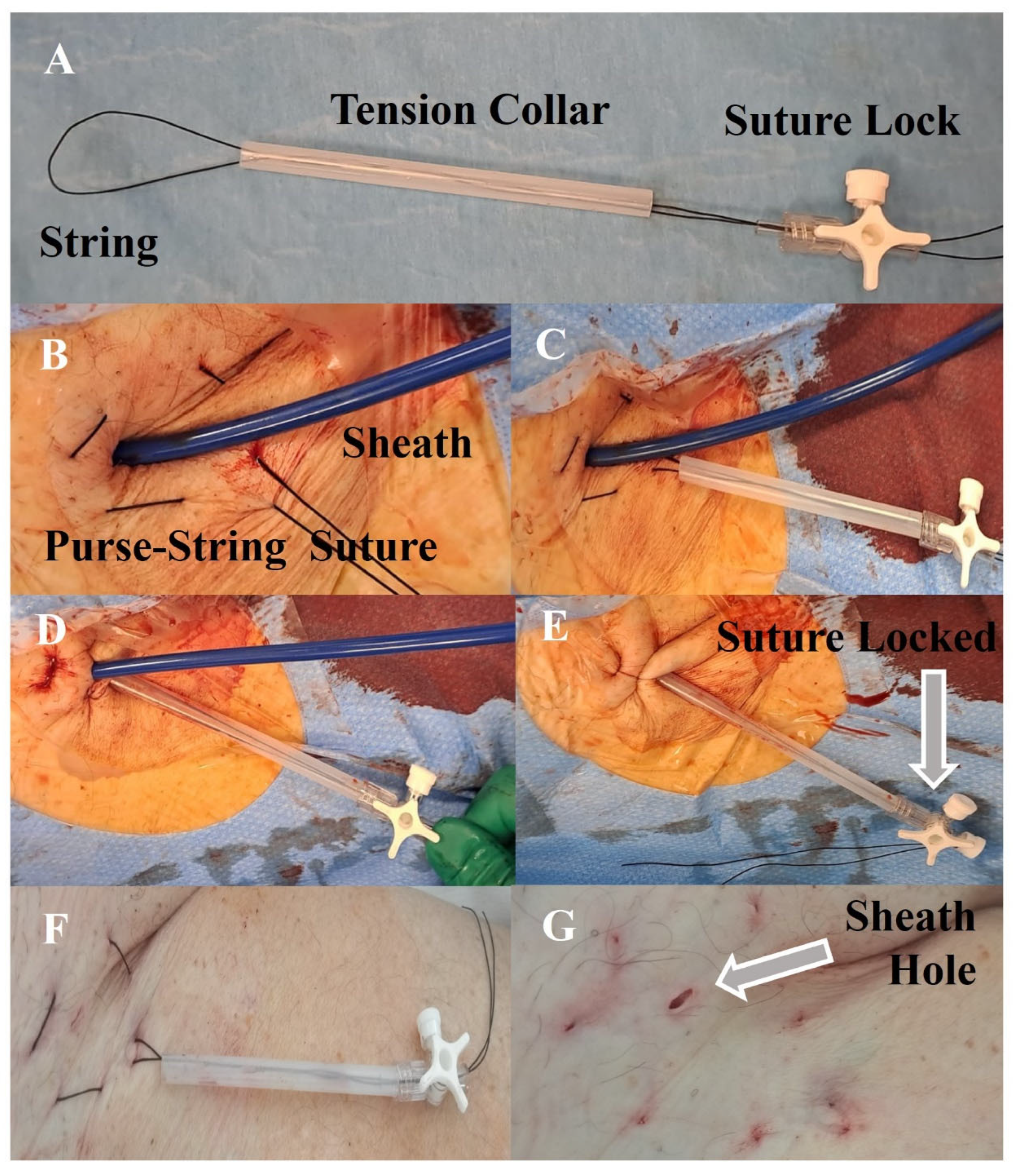 Closure of jejunal lumen with a purse-string suture device 125 | Download  Scientific Diagram