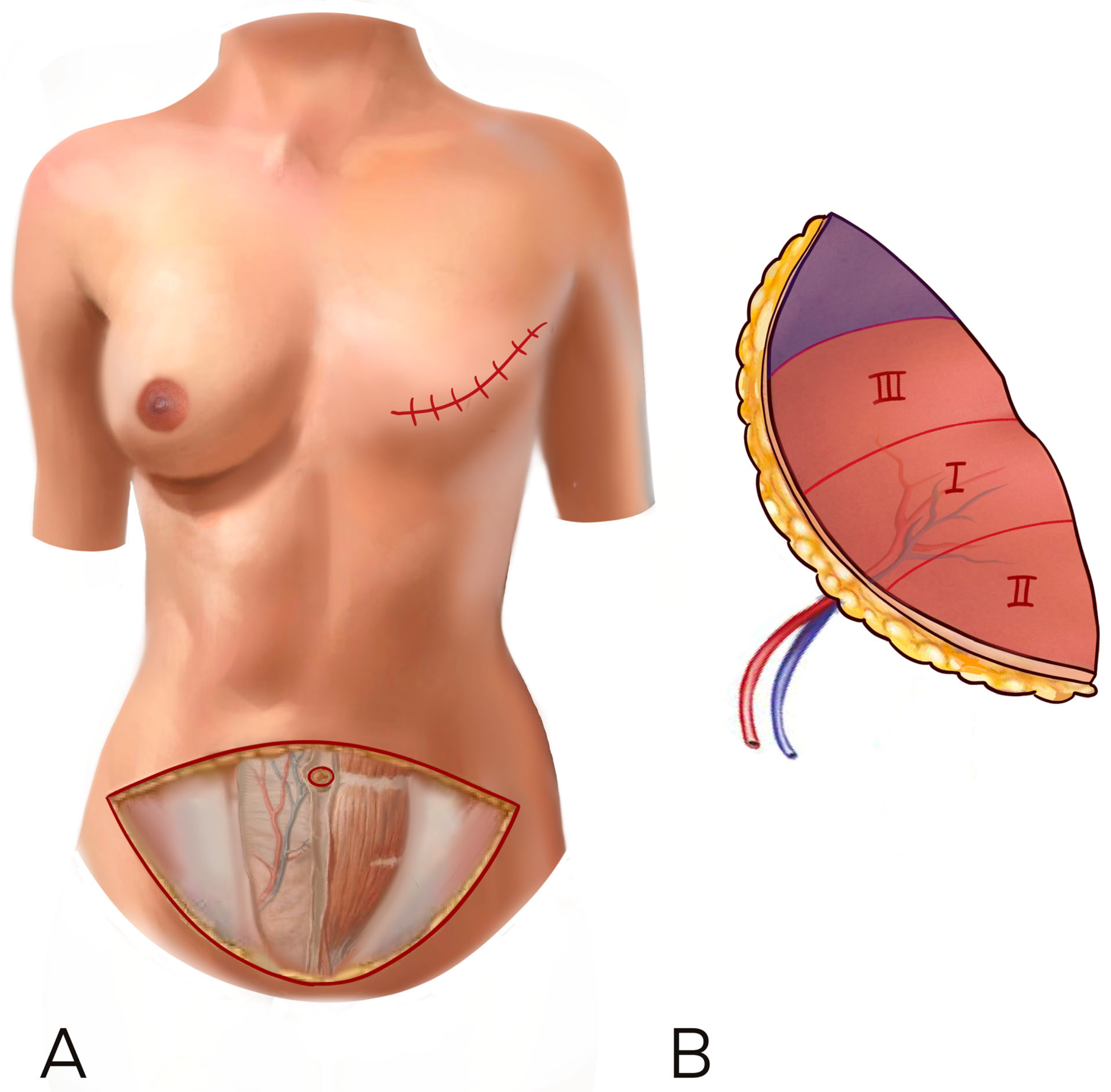 What is DIEP Flap Surgery?, Department of Surgery