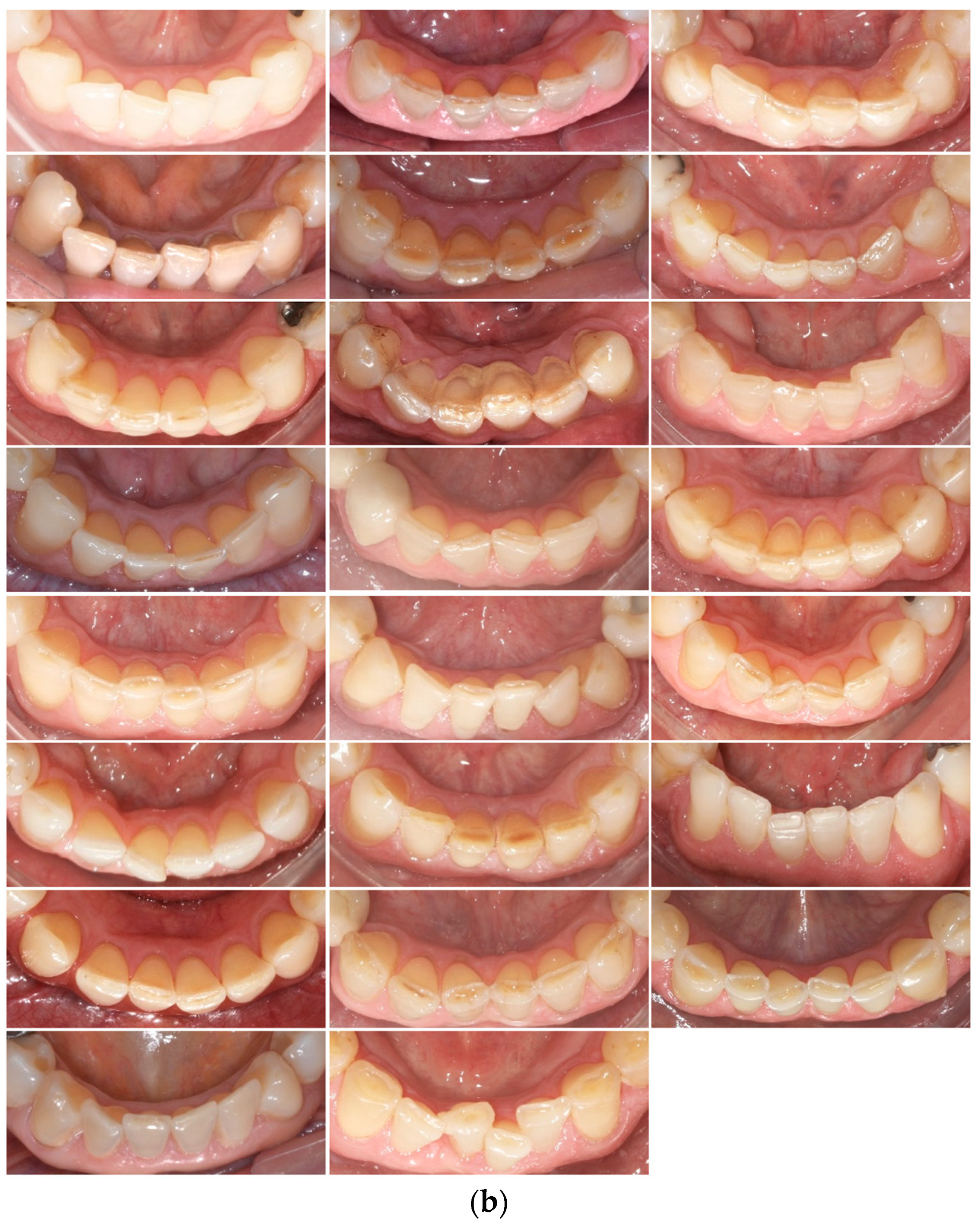 JCM | Free Full-Text | Erosive Tooth Wear in Subjects with Normal  Occlusion: A Pioneering Longitudinal Study up to the Age of 60