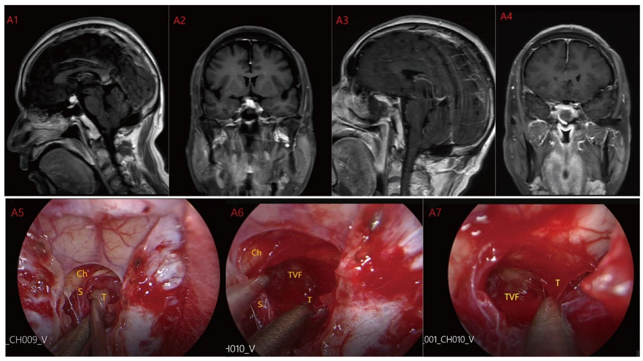 A Full View of Papillary Craniopharyngioma Based on Expanded