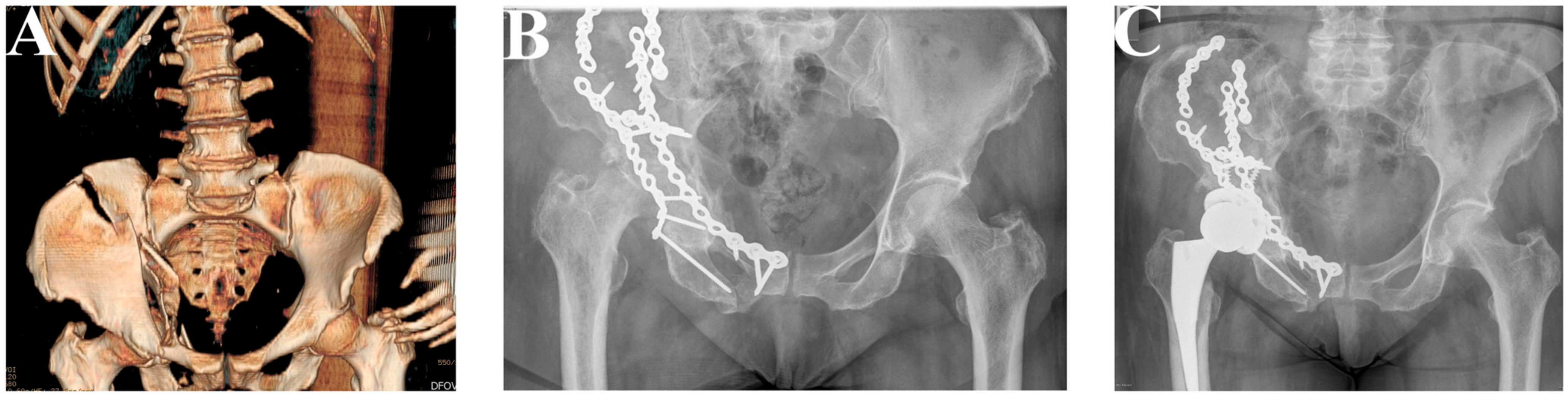The Association between Acetabulum Fractures and Subsequent