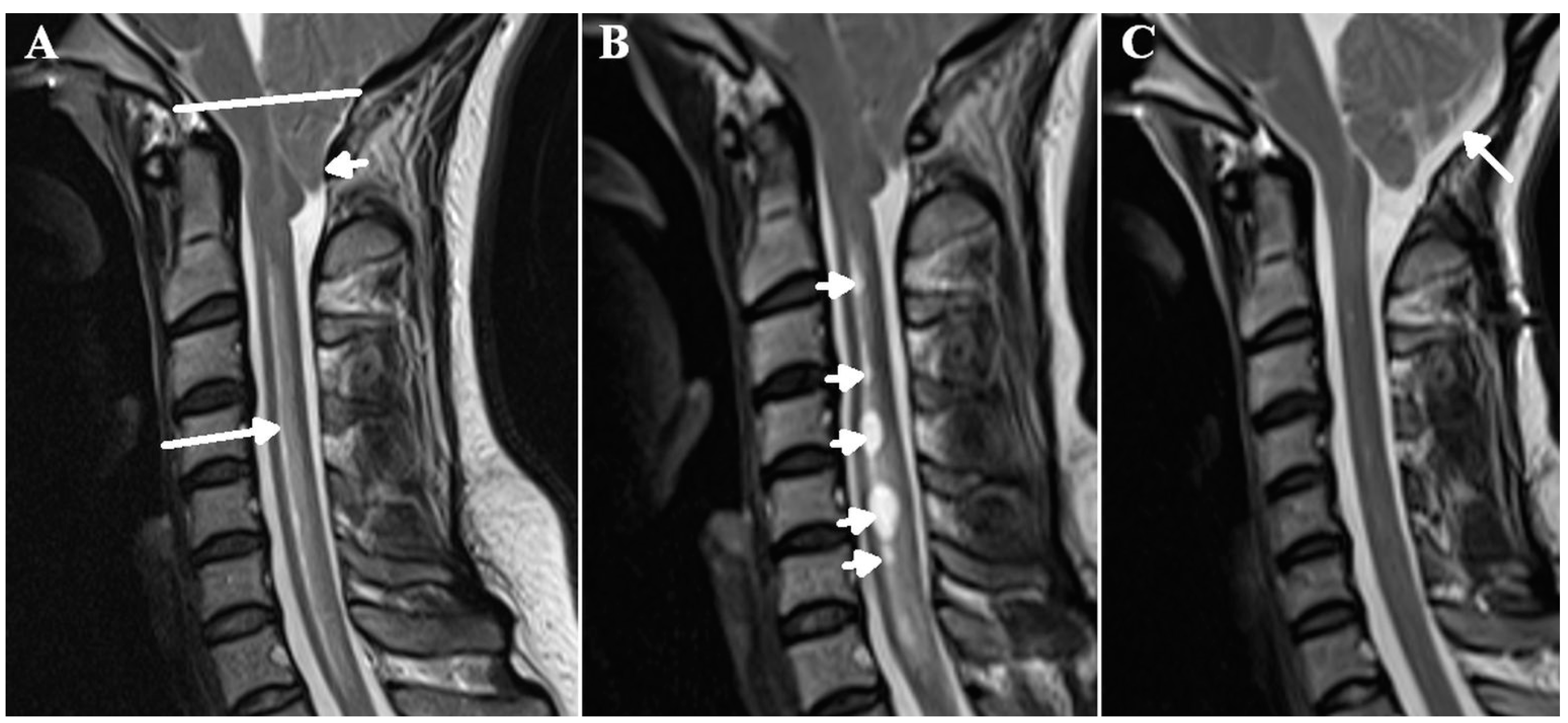 JCM | Free Full-Text | Syringomyelia Is Associated with a Reduction in  Spinal Canal Compliance, Venous Outflow Dilatation and Glymphatic Fluid  Obstruction